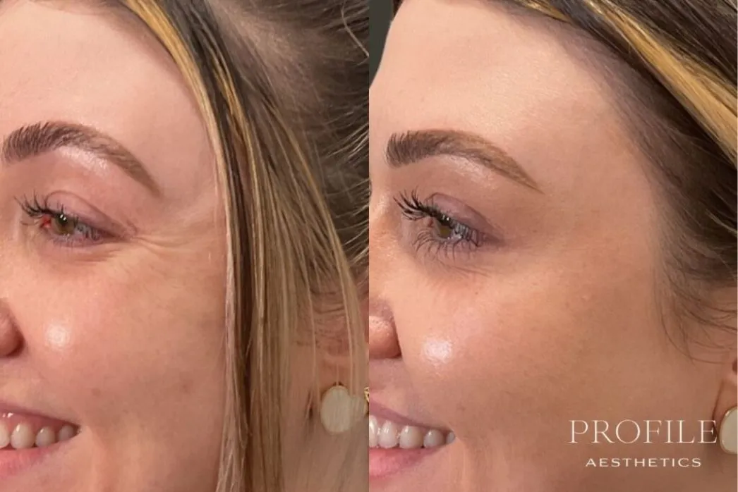 Before and after side profile showing reduced crow's feet and smoothed eye area after neurotoxin treatment