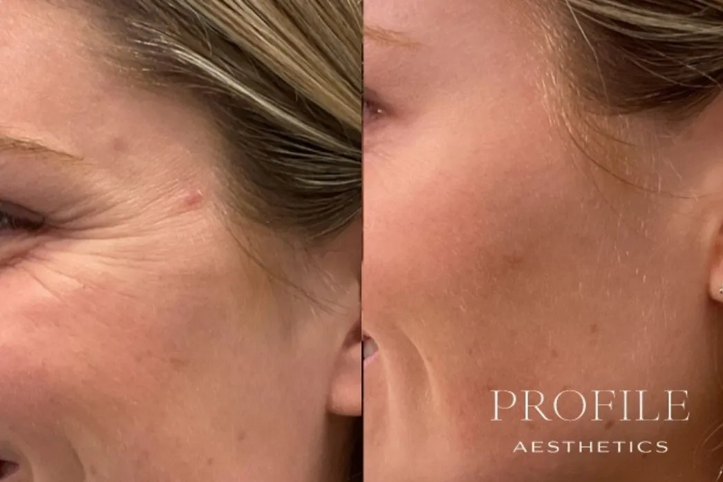 Before and after side profile showing reduced forehead lines and smoother skin texture after neurotoxin treatment