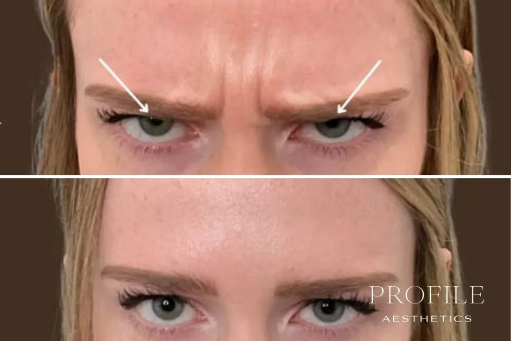 Diagram marking injection sites on forehead between brows, with before and after comparison below