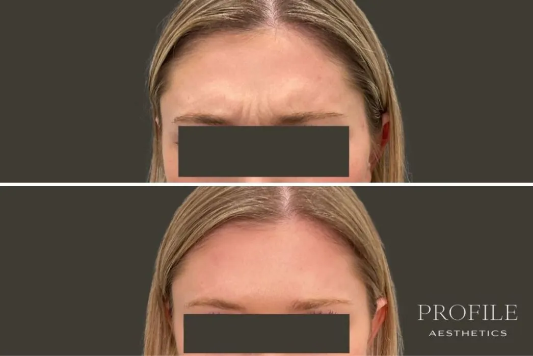 Before and after forehead comparison showing reduced forehead lines and smoother appearance