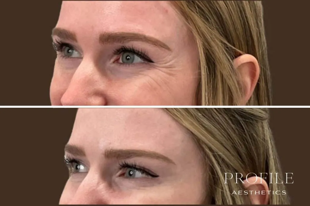 Before and after side profile showing reduced crow's feet and crows feet lines near eyes after neurotoxin treatment
