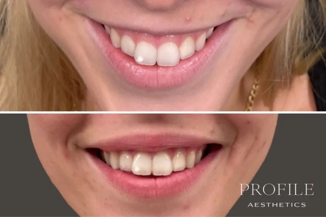 Before and after comparison of smile showing fuller lips and smoother appearance