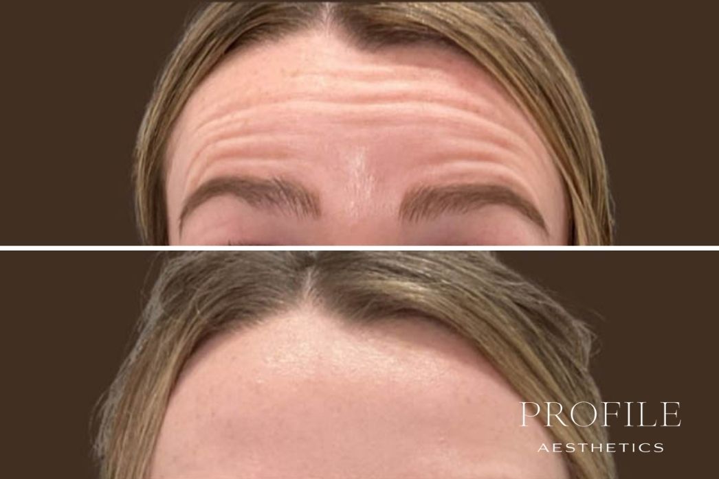 Botox and Neurotoxins (4)