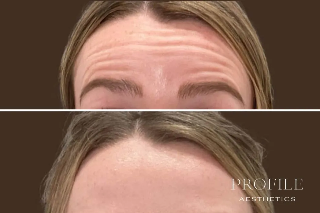 Before and after comparison of forehead wrinkles, with reduced lines visible in the lower image