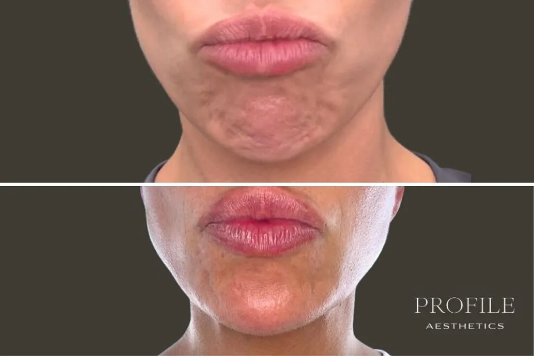 Before and after comparison of lower face showing reduced wrinkles around mouth and chin