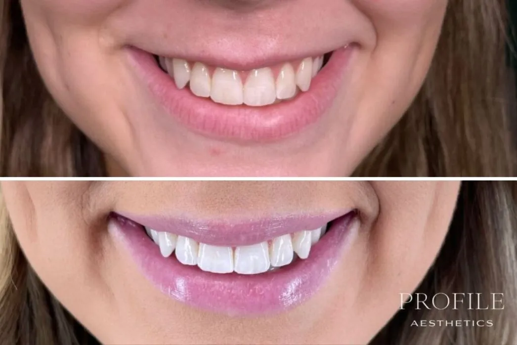 Before and after comparison of smile showing enhanced lip fullness and definition