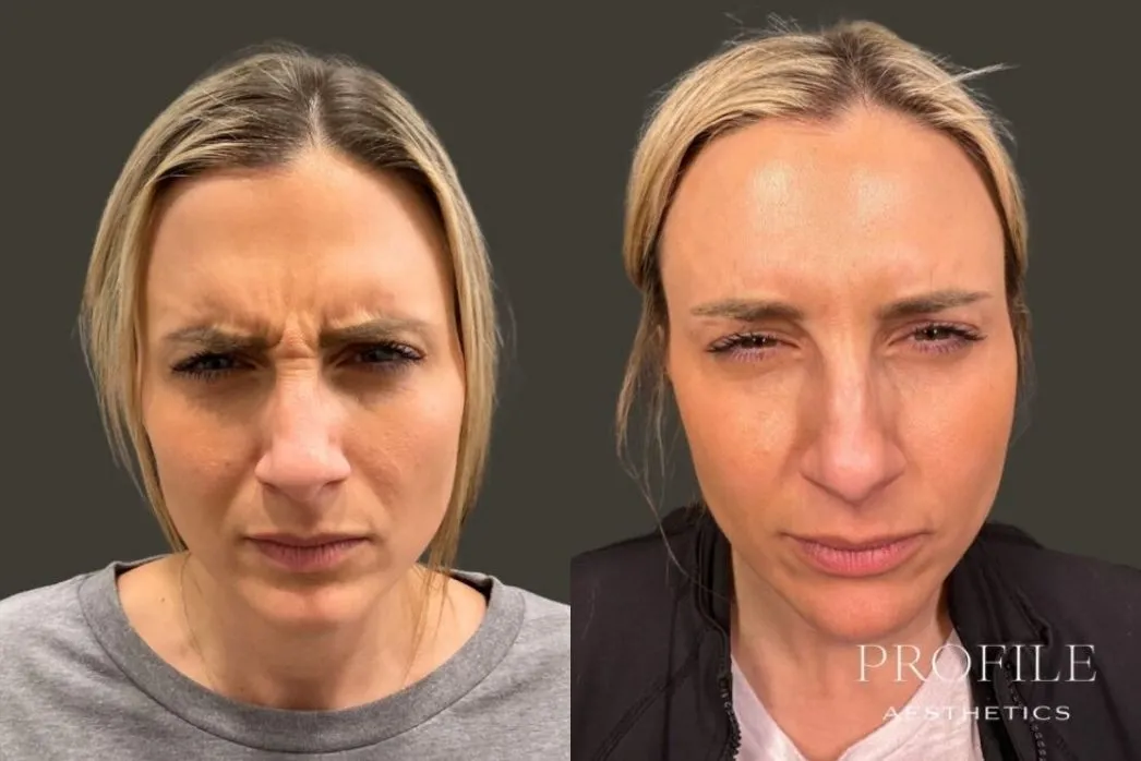 Before and after comparison of forehead and brow area showing reduced frown lines