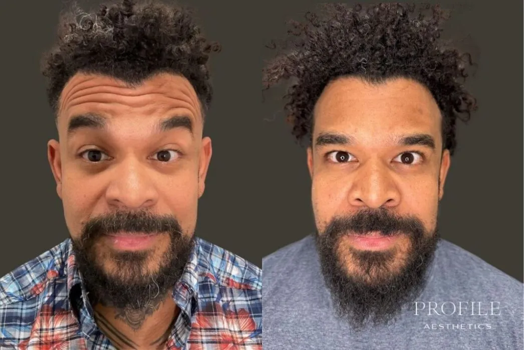 Man facing forward before and after Botox treatment showing reduced forehead creases