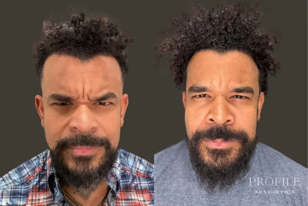 Before and after comparison of male patient's forehead showing smoothed expression lines