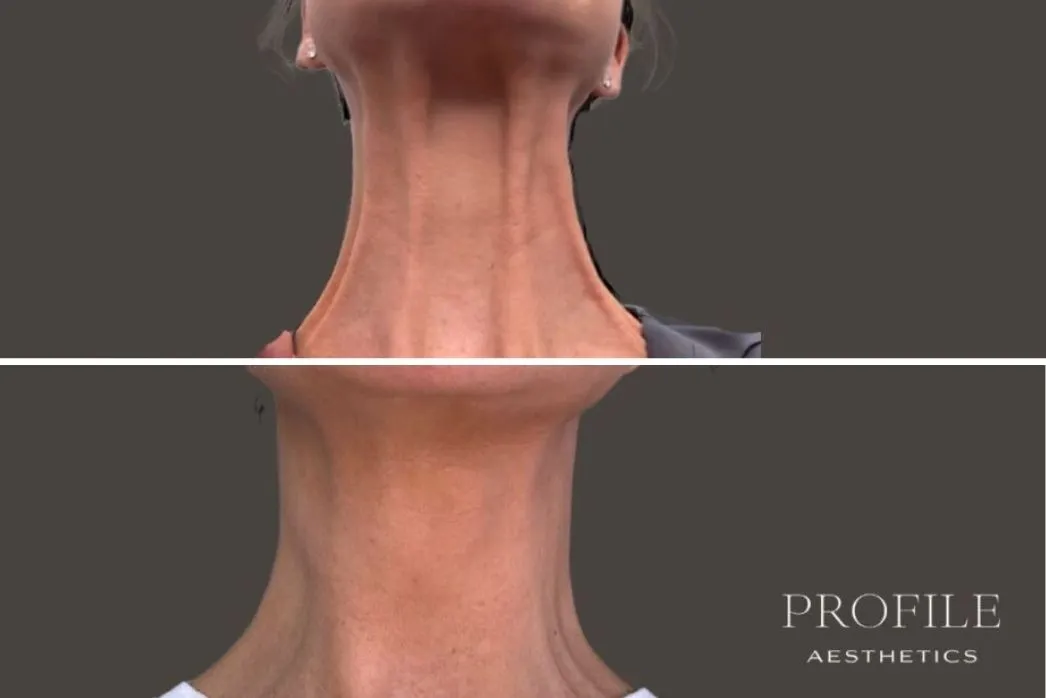 Before and after neck comparison showing reduced wrinkles and improved skin texture