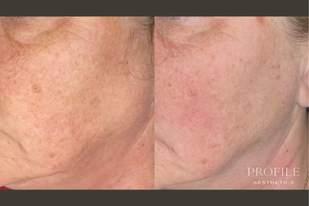 Before and after cheek skin comparison showing improved texture and tone after chemical peel