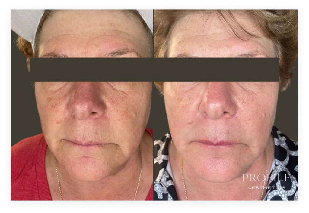 Before and after full-face comparison of woman showing reduced wrinkles and improved skin texture