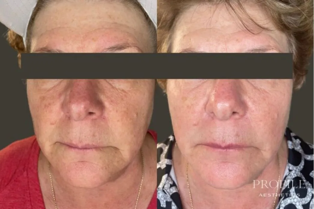 Before and after facial comparison showing skin texture improvement from chemical peel treatment