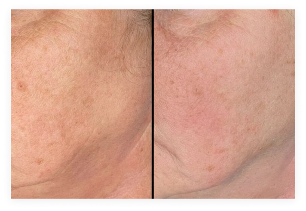 Before and after comparison of skin texture on chest area showing improved appearance