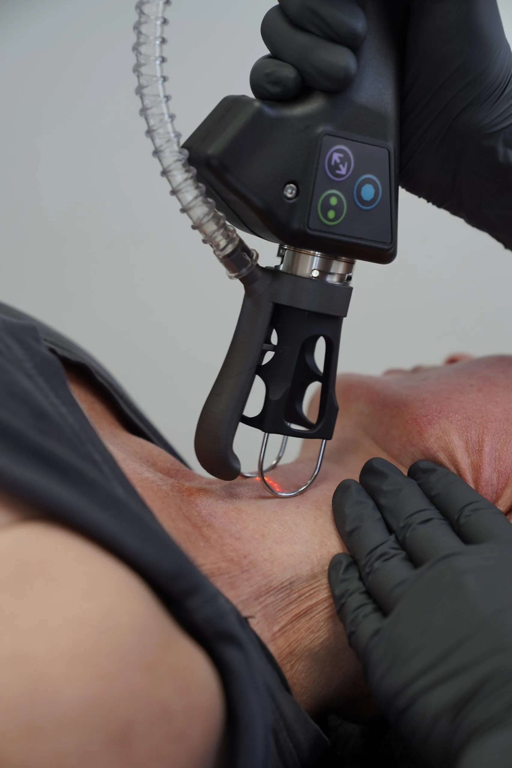 Close-up of CoolPeel laser handpiece with control panel being used on patient's arm