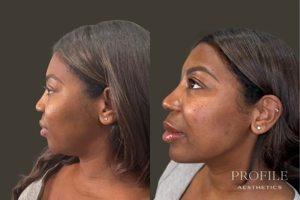 Before and after profile views showing lip and chin enhancement with dermal fillers
