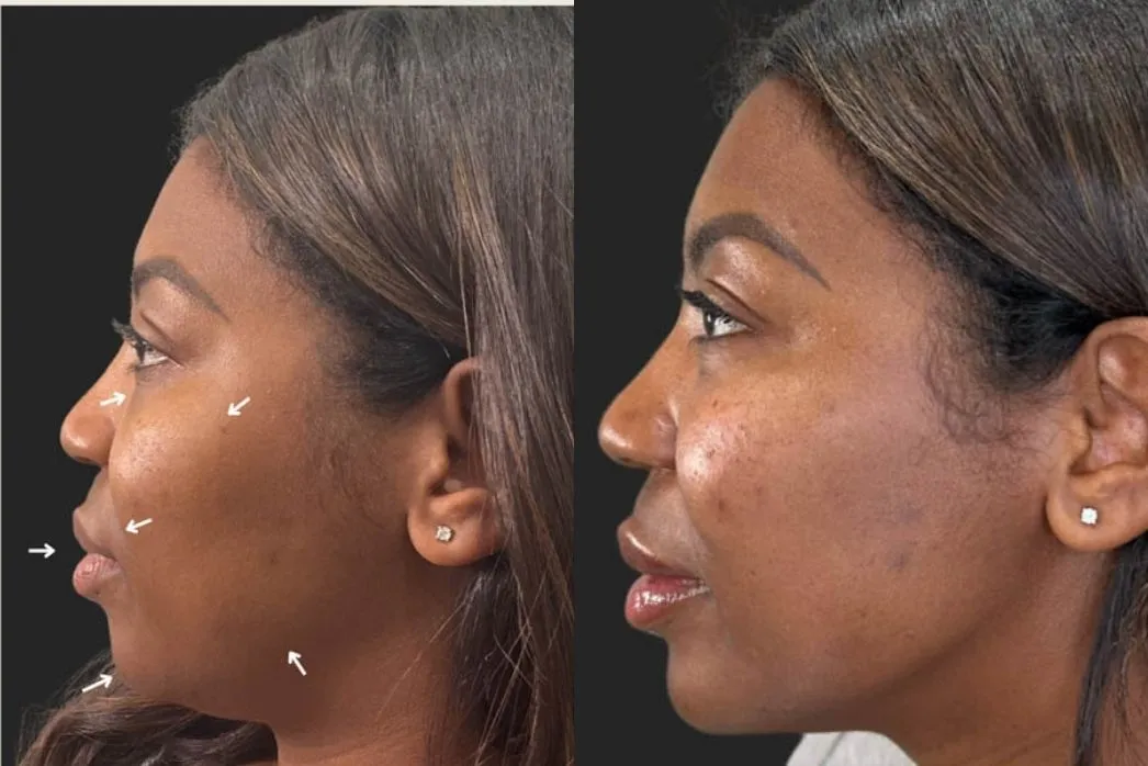 Before profile with treatment area markers and after view showing dermal filler results