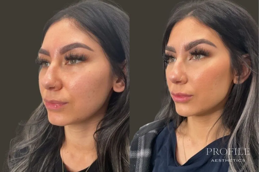 Before and after profile views of a woman's face showing dermal filler results to the cheeks and lips