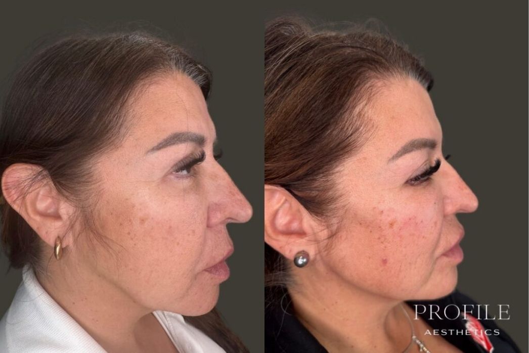 Dermal Fillers (13)