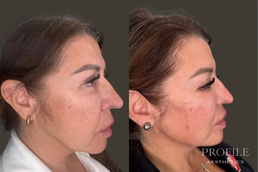 Before and after side profile views of a woman's face showing dermal filler results to the cheeks and under-eye area
