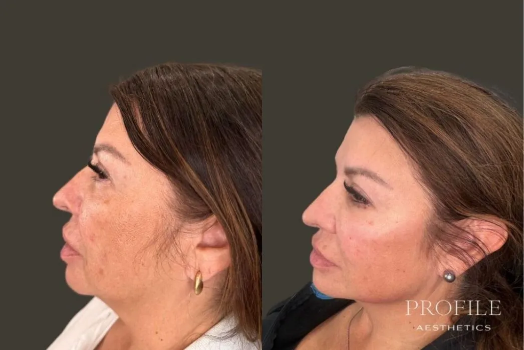 Before and after side profile views of a woman's face showing dermal filler results to the chin and jawline