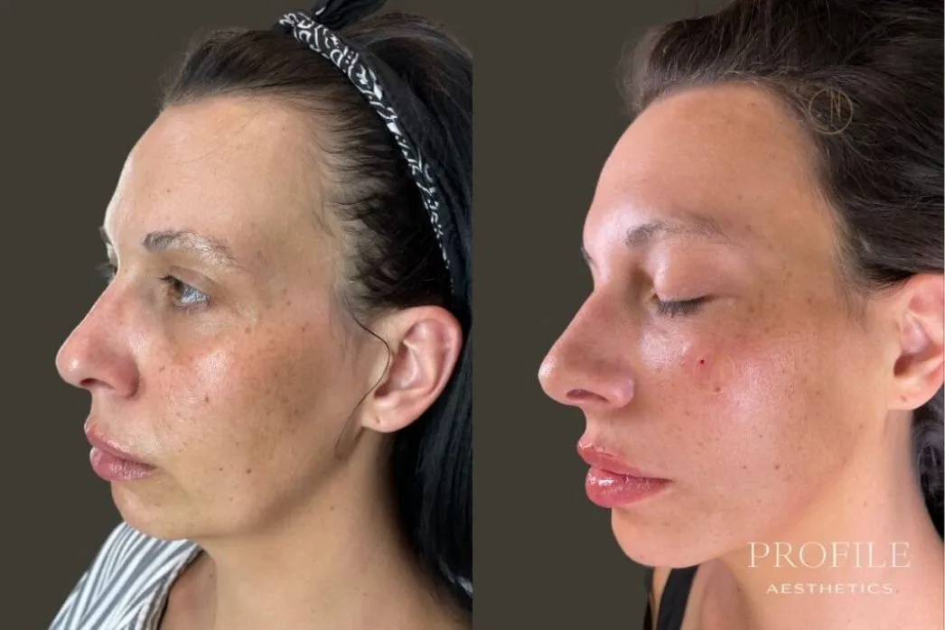 Before and after side profile views of a woman's face showing dermal filler results to the lips and chin