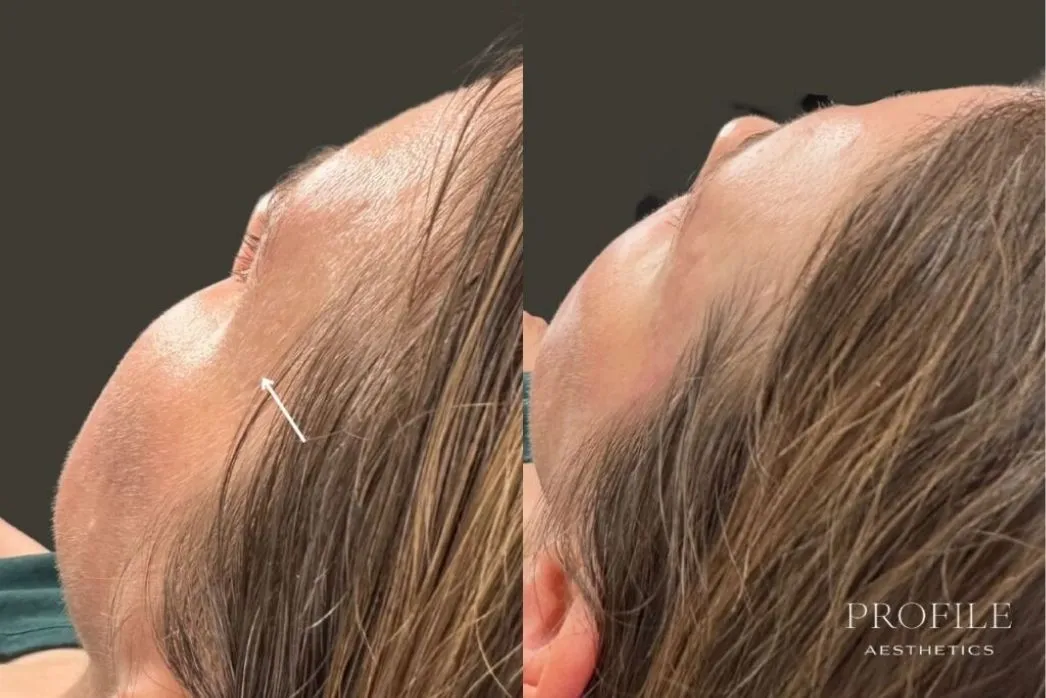 Before and after back views of a woman's head and neck showing dermal filler results to create neck definition