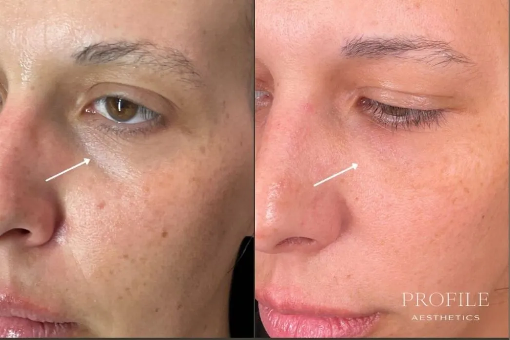 Before and after dermal filler treatment to under-eye area, showing reduced hollowing and fine lines