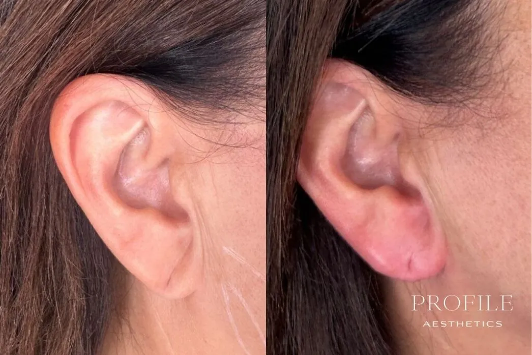 Before and after dermal filler treatment to ear, showing enhanced shape and definition