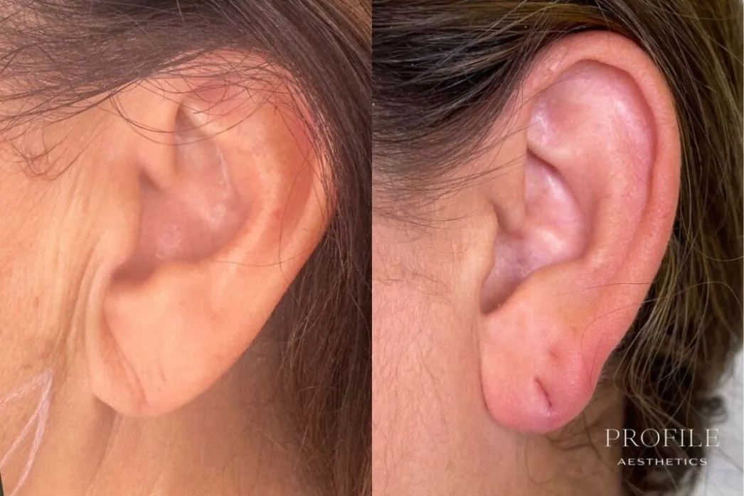 Before and after dermal filler treatment to ear, showing improved contour and volume