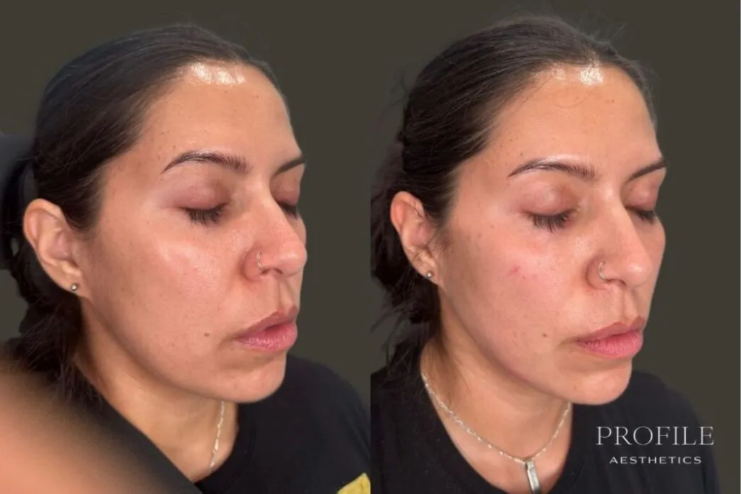 Before and after dermal filler treatment showing profile view with improved facial volume and definition