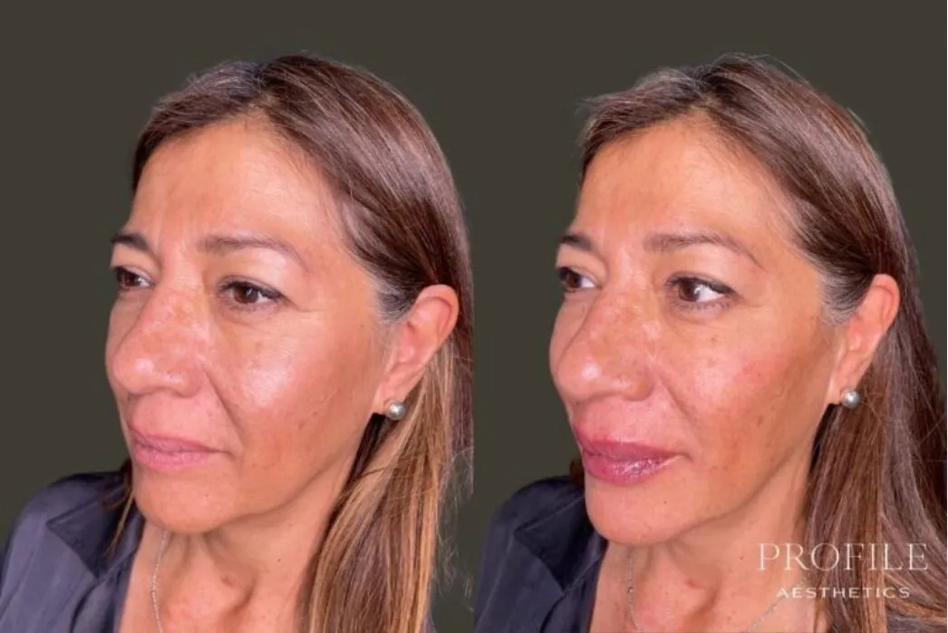 Before and after dermal filler treatment showing three-quarter profile with fuller lips and enhanced facial contours