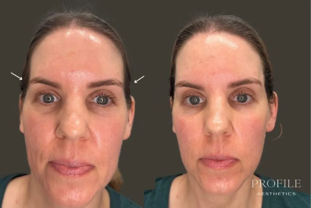 Before and after dermal filler treatment showing frontal view with reduced forehead lines and improved facial symmetry