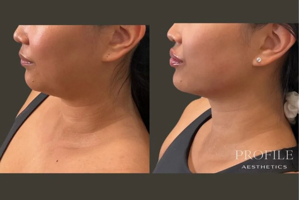 Before and after dermal filler treatment showing side profile with enhanced jawline definition and chin projection