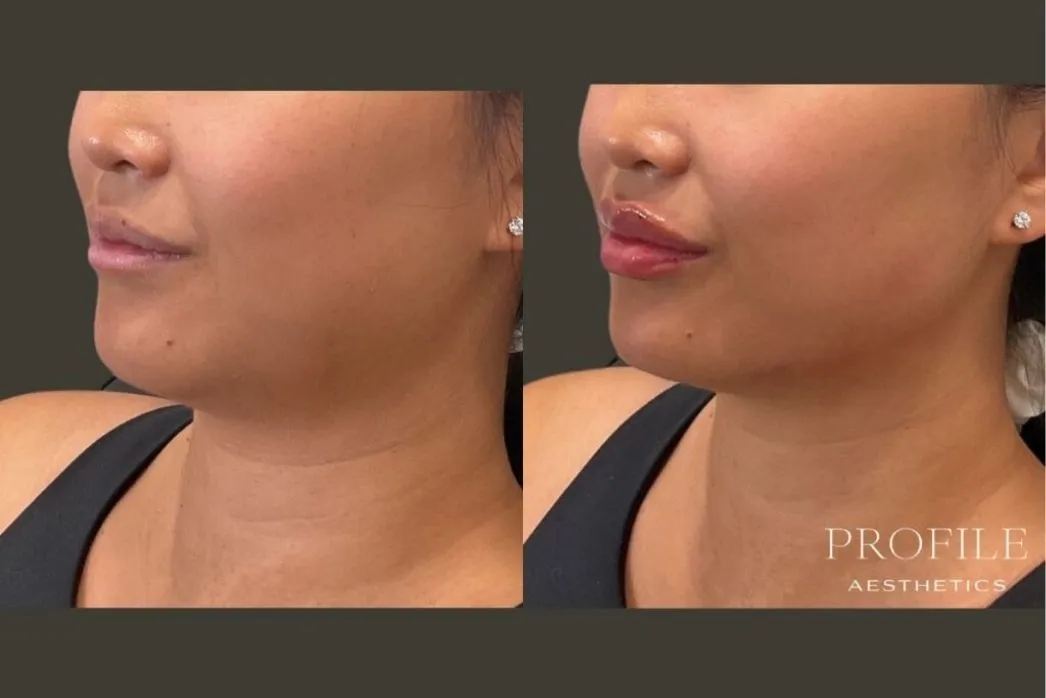 Before and after dermal filler treatment showing side profile with fuller lips and improved lip definition