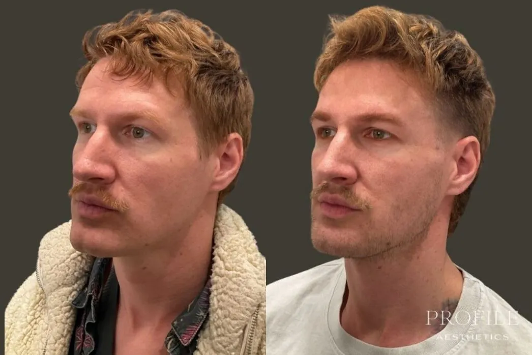 Before and after side profile view of male patient showing dermal filler results