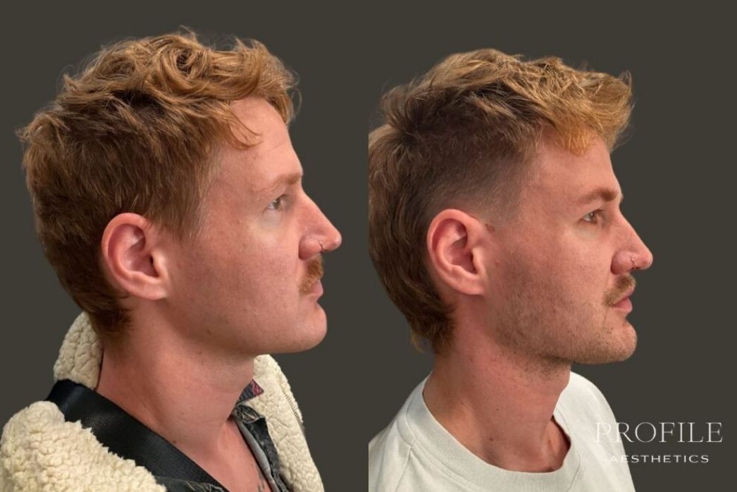 Dermal Fillers (4)