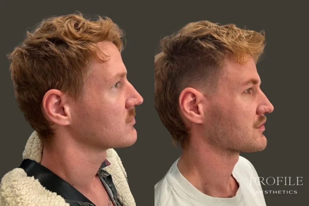 Before and after side profile view of male patient showing dermal filler results