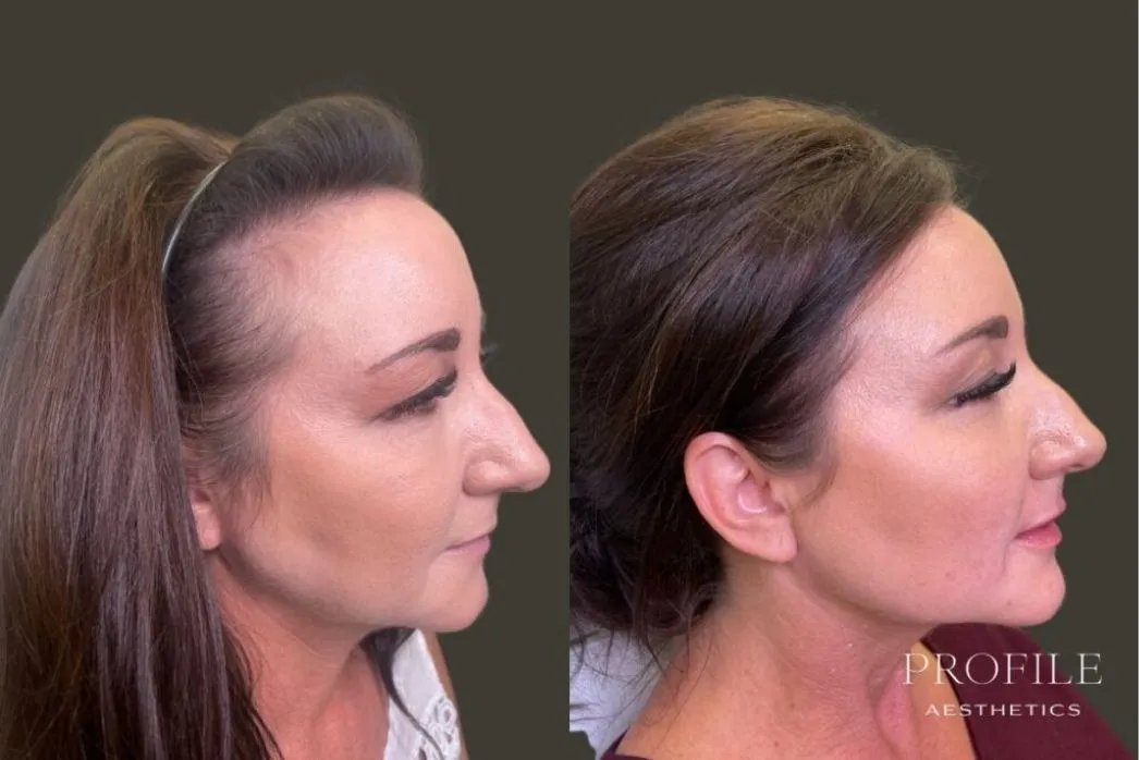 Before and after profile views showing enhanced cheekbones and chin definition