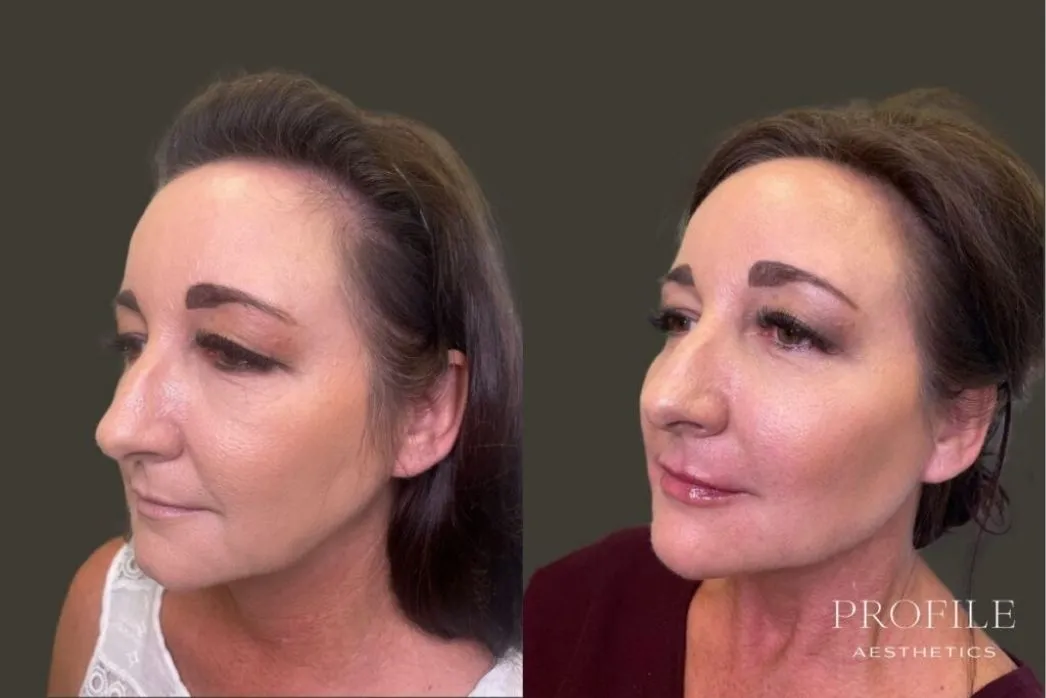 Before and after side profile view of female patient showing dermal filler results
