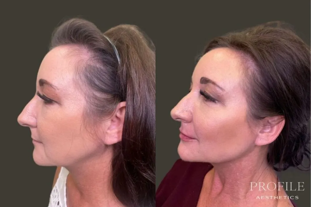 Before and after profile views showing facial contouring with dermal fillers