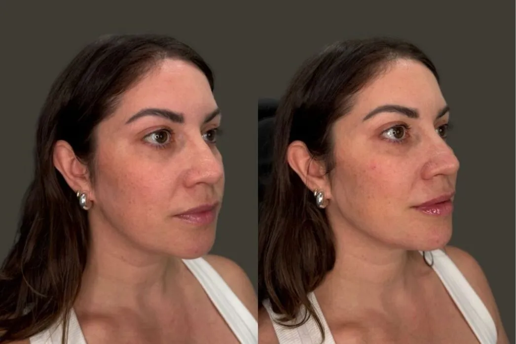 Before and after three-quarter views showing enhanced facial volume and definition