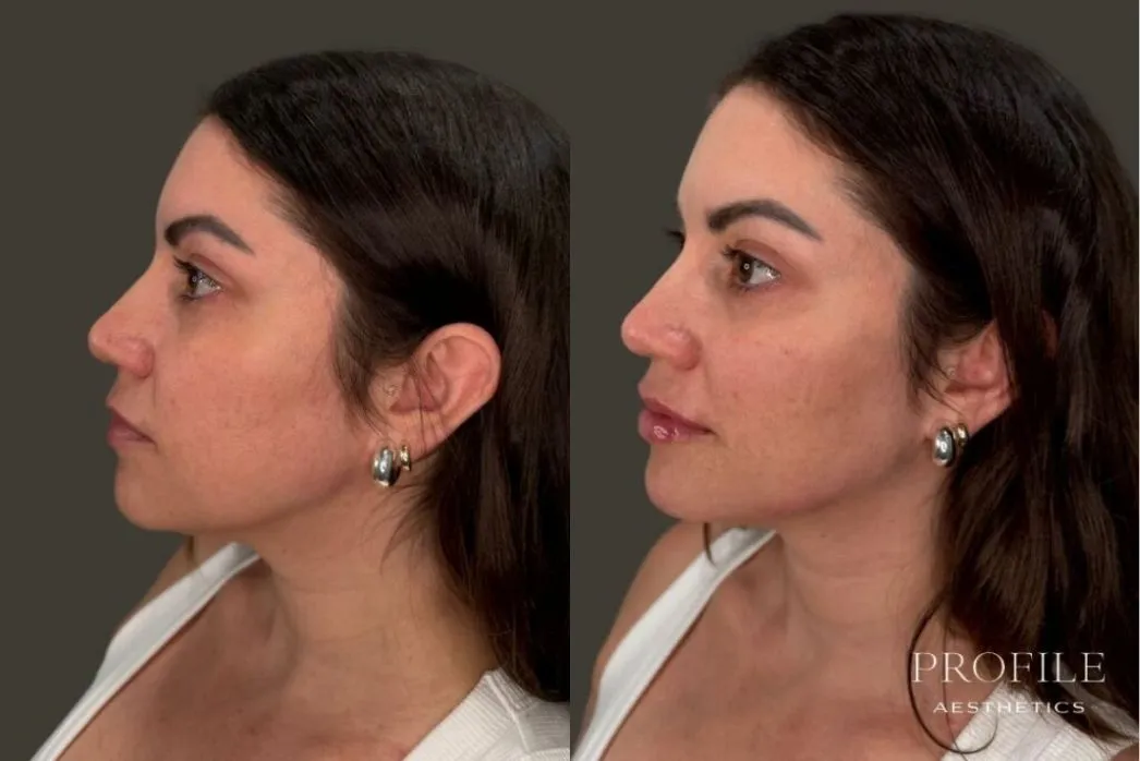 Before and after profile views showing improved lip fullness and chin projection