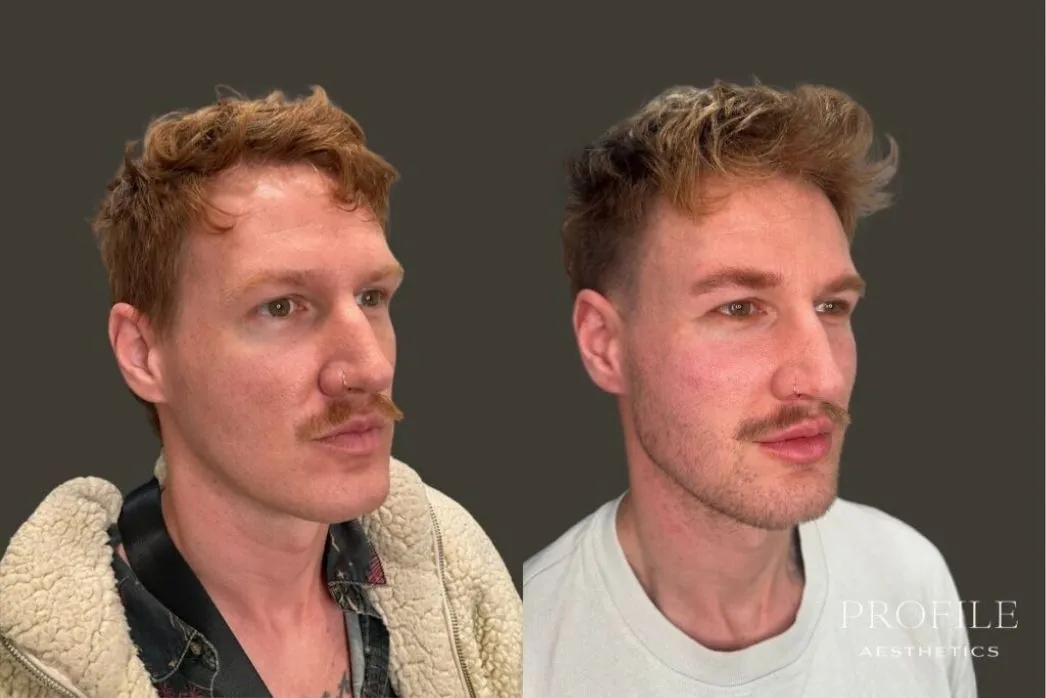 Before and after frontal view of male patient showing dermal filler results