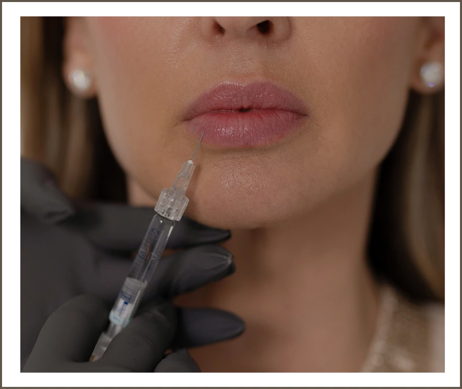 Gloved hand holding dermal filler syringe near patient's lips during injection procedure