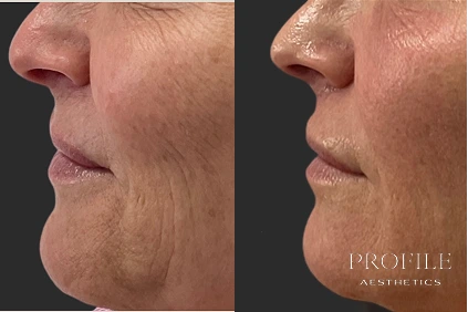 Before and after side profile showing improved jawline definition and reduced sagging