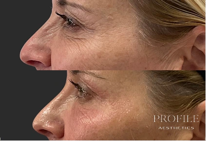 Before and after side profile showing smoother skin texture and reduced fine lines around eye area