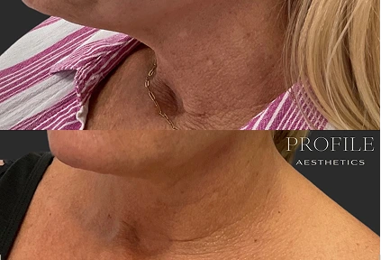 Before and after showing reduced neck laxity and improved skin tightness