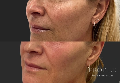 Before and after showing improved facial volume and skin smoothness in cheek and jawline area