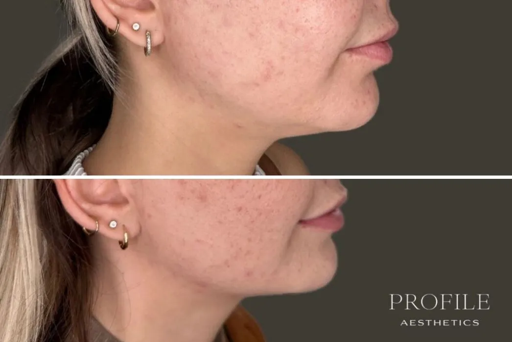Before and after side profile showing improved chin definition